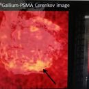 68Ga PSMA Cerenkov Afbeelding
