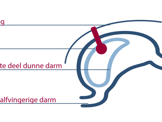 Gastro-jejunostomie illustratie interventieradiologie NL