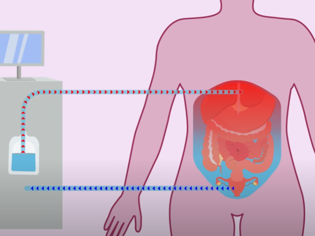 Videostill eierstokkanker debulking operatie met HIPEC