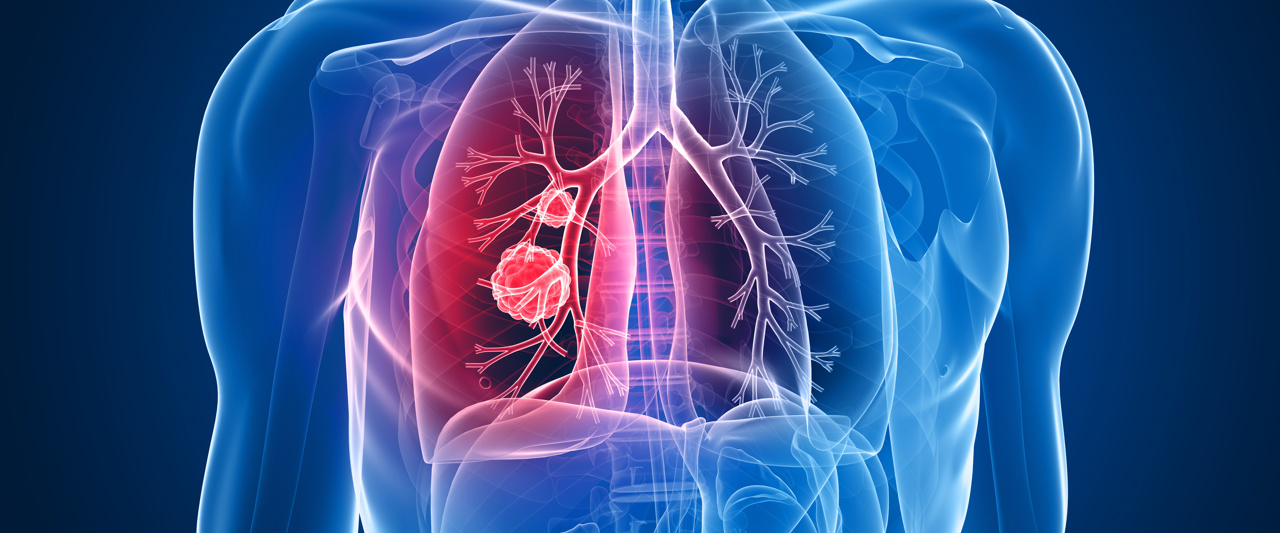 Longkanker Transparant NVALT