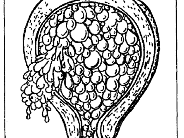 Trofoblast 2 Voorhetgesprek Druiventros Mola
