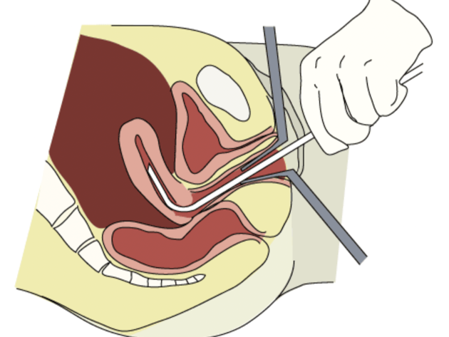 Trofoblast 2 Voorhetgesprek Vacuum