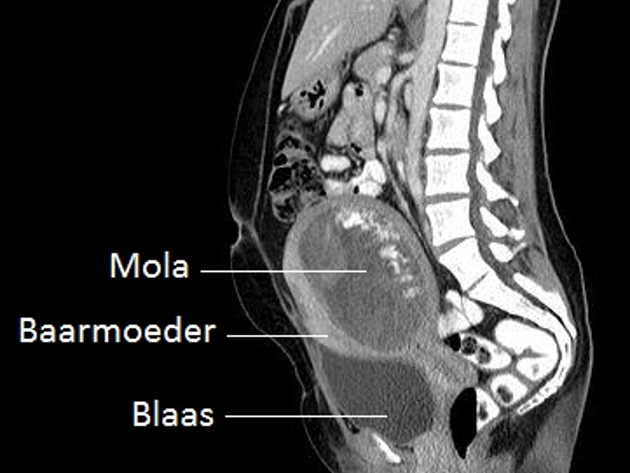 Trofoblast 4 Voorhetgesprek CT Mola