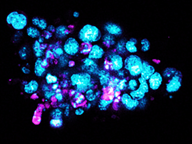Borstkanker Organoids