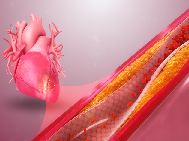 Coronary Artery Disease Wikimedia Commons Www.Scientificanimations.Com