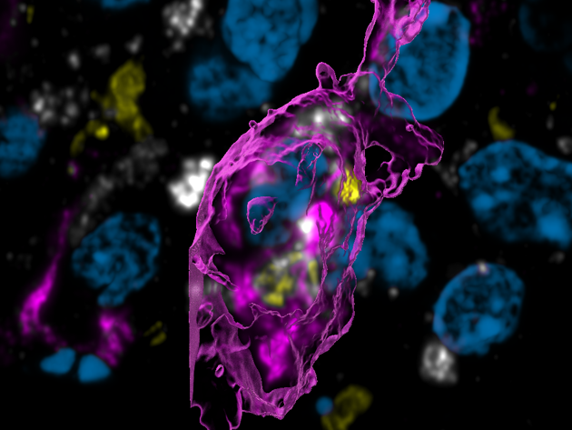 Figuur A - vet-geladen macrofaag in glioblastoom die myeline opneemt