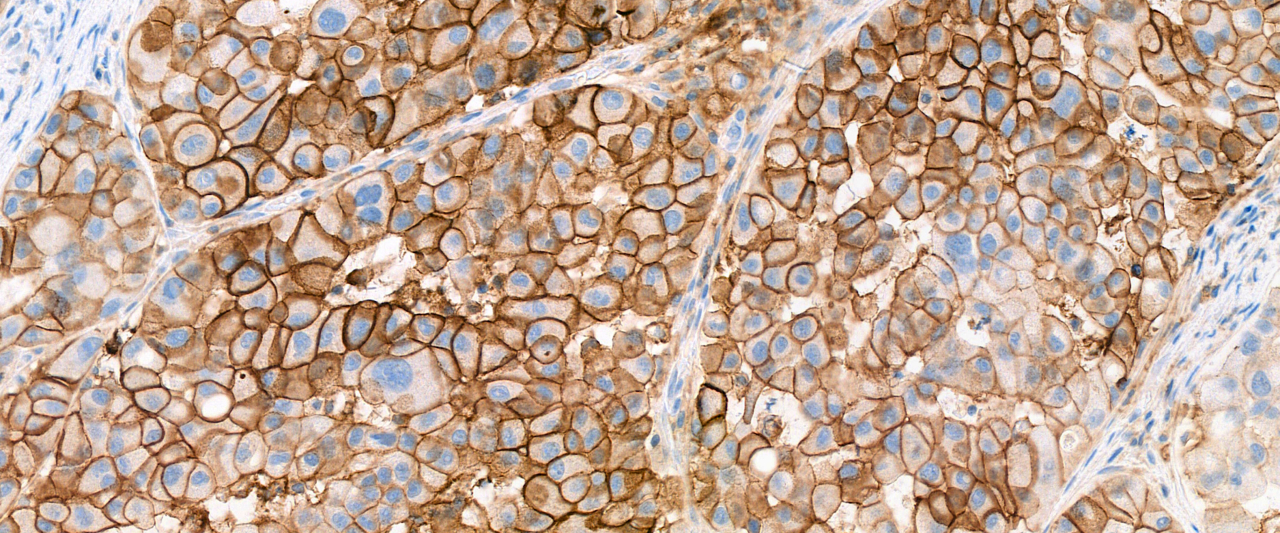 Foto 6 Long Adenocarcinoom Pd L1